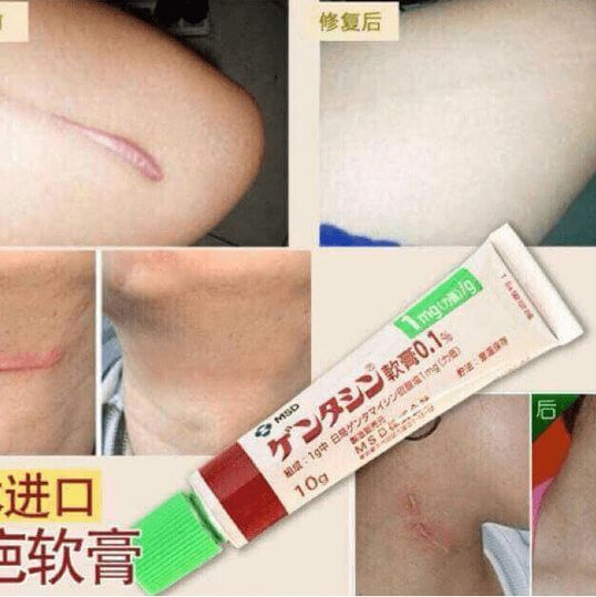Công dụng của kem trị sẹo Gentacin của Nhật Bản