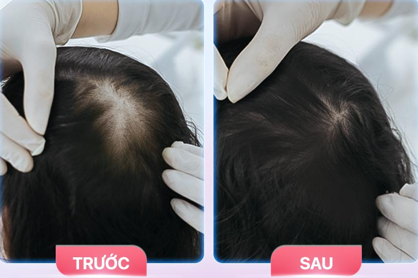 Hướng dẫn cách để tóc mọc trở lại